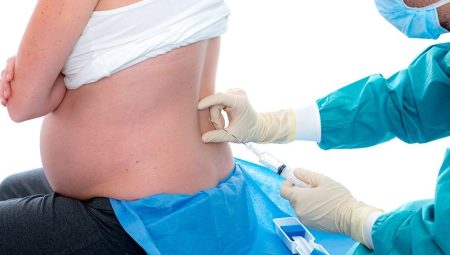Spinal Anestezi Vücuttan Kaç Günde Atılır?