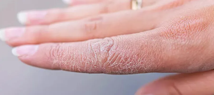 Cilt Kuruluğunun Nedenleri Nelerdir?