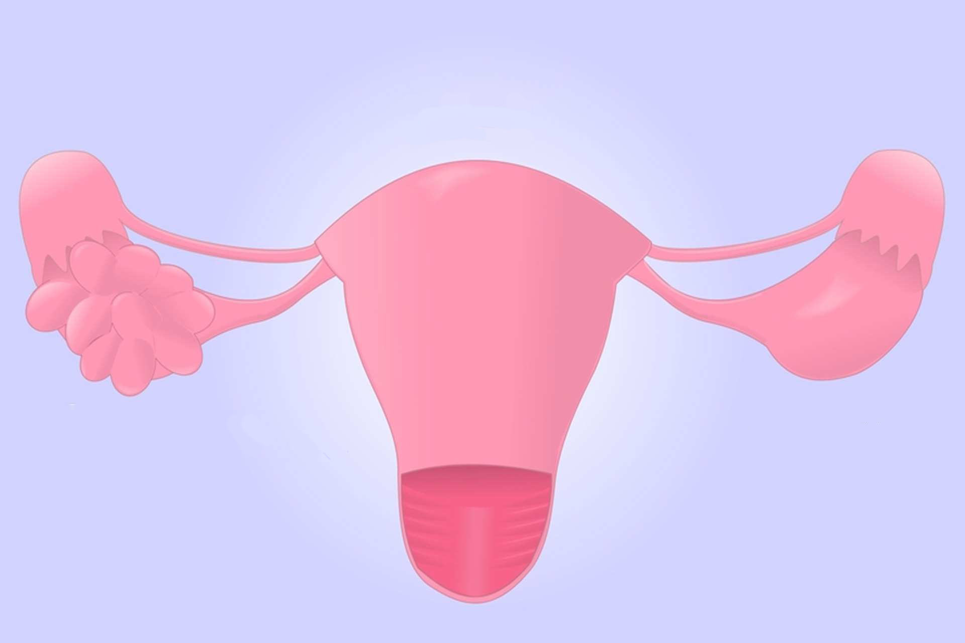 Yumurtalık Kisti Nedir? Neden Olur?