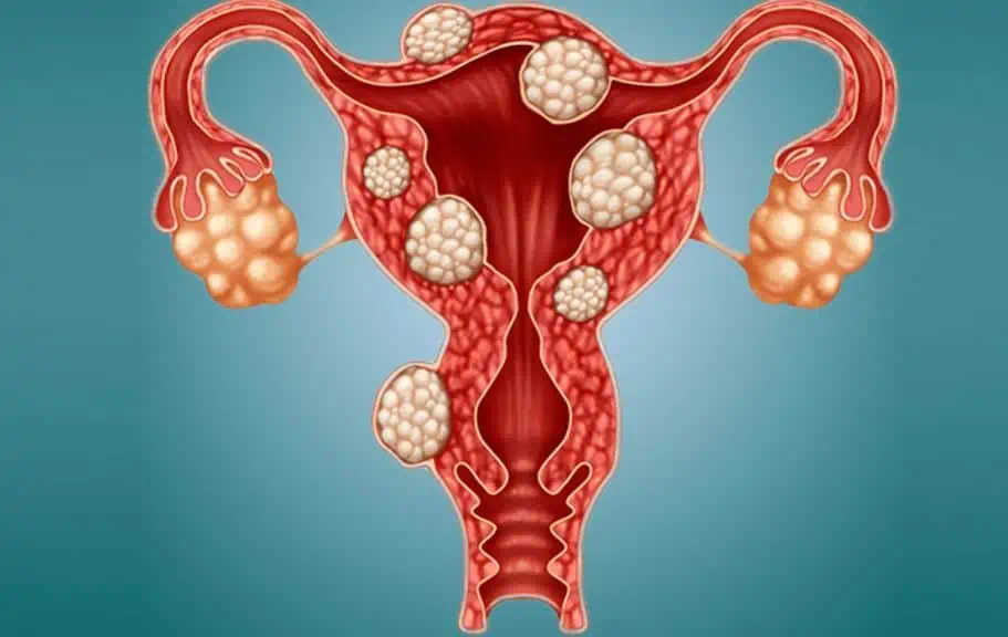 Yumurtalık Kisti Nedir ve Neden Oluşur?