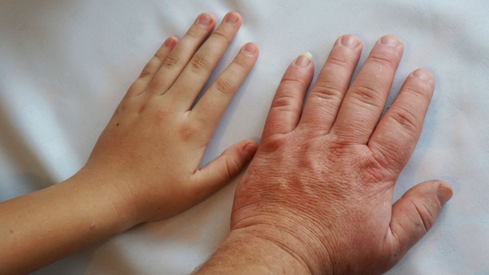 Acromegaly Nedir? Neden Olur? Belirtileri ve Tedavi Yöntemleri