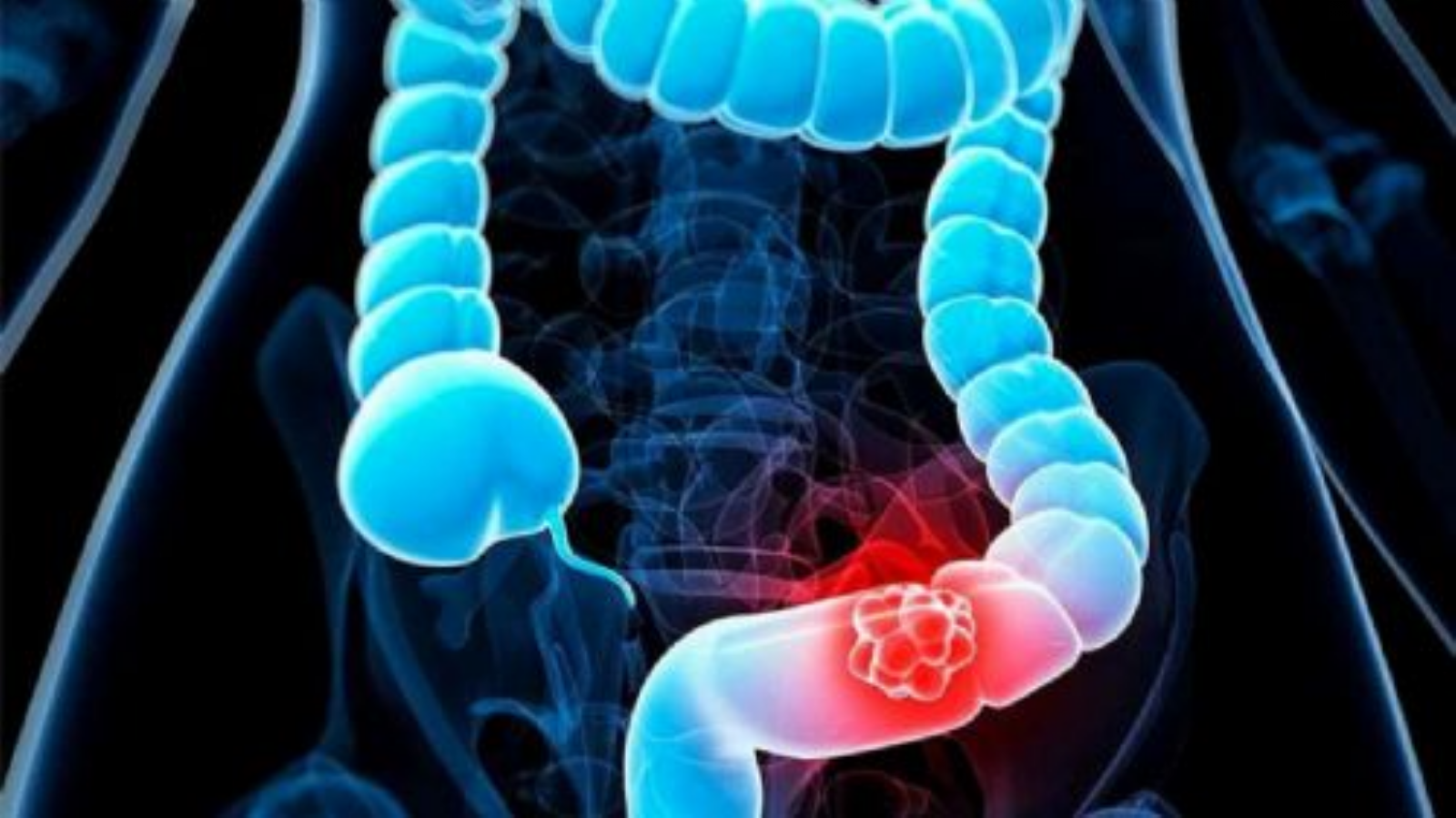 Ailesel Adenomatöz Polipozis Nedir? Neden Olur? Belirtileri Ve Tedavi Yöntemleri