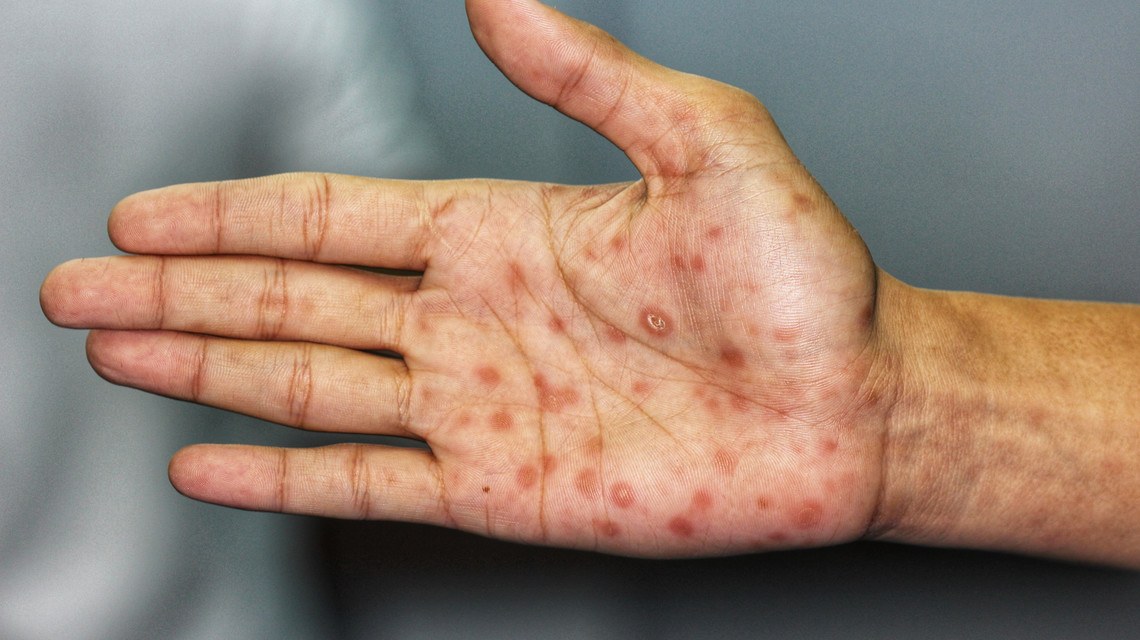 Cinsel Yolla Bulaşan Hastalıklar Nelerdir?