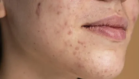 Fraksiyonel Lazer Nedir, Ne İşe Yarar, Akne İzlerini Geçirir Mi?