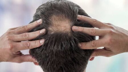 Saç Dökülmesinin Nedenleri Nelerdir?