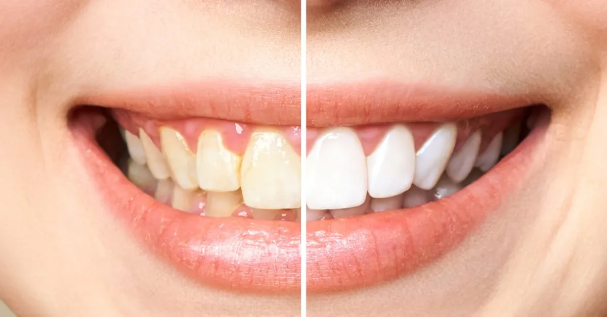 Diş Beyazlatmanın Genel Prensipleri Nelerdir?