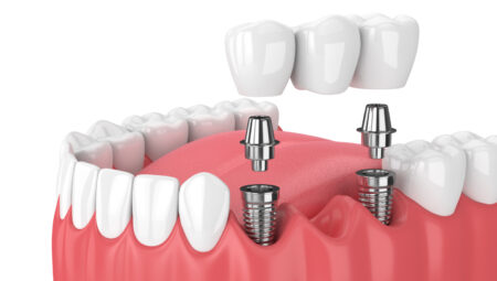 İmplant Tedavisi Nedir?