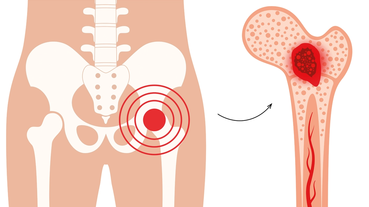 Kemik Hastalıkları Nelerdir? Belirtileri, Nedenleri ve Tedavi Yöntemleri