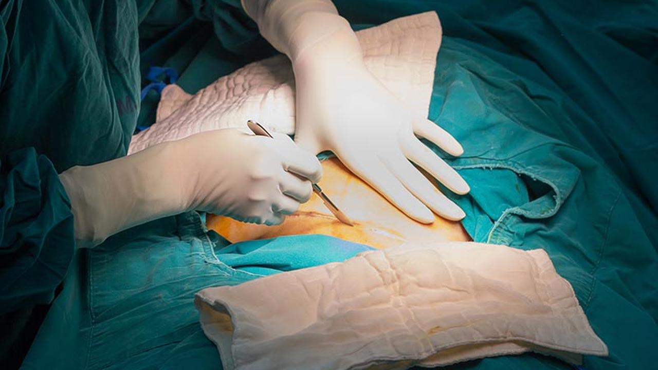 Sezaryen Doğum Nedir ve Neden Yapılır?