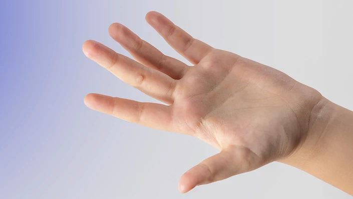 Siğil Nedir ve Neden Oluşur?