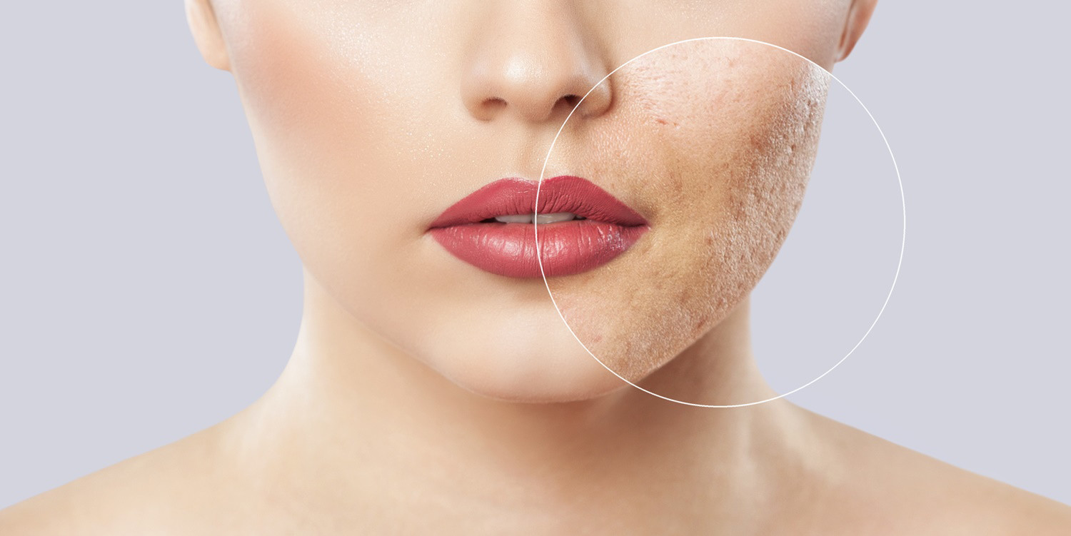 Akne ve Sivilce Nedir? Neden Olur? Nasıl Tedavi Edilir?