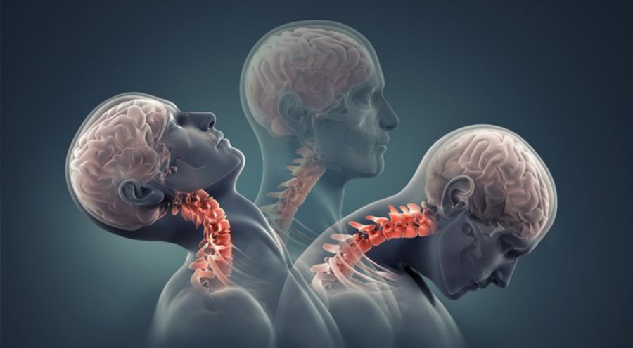 Boyun Fıtığı Nedir? boyun Fıtığı Belirtileri Nelerdir?