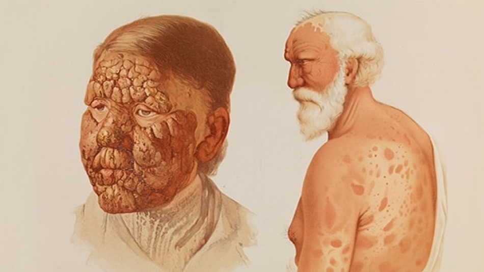 Cüzzam Nedir? Cüzzam Nasıl Bulaşır?