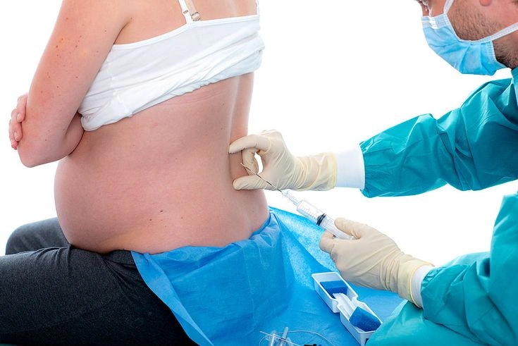 Epidural Doğum Nedir? Epidural Doğumun Avantajları Nelerdir?