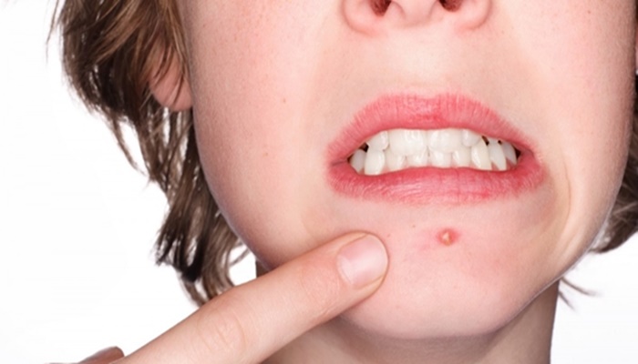 Karaciğer Yağlanması Sivilce Yapar mı?