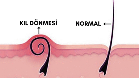 Kıl Dönmesi Nedir ve Neden Oluşur?