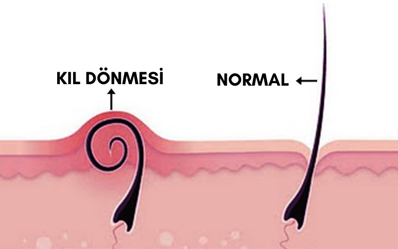 Kıl Dönmesi Nedir ve Neden Oluşur?