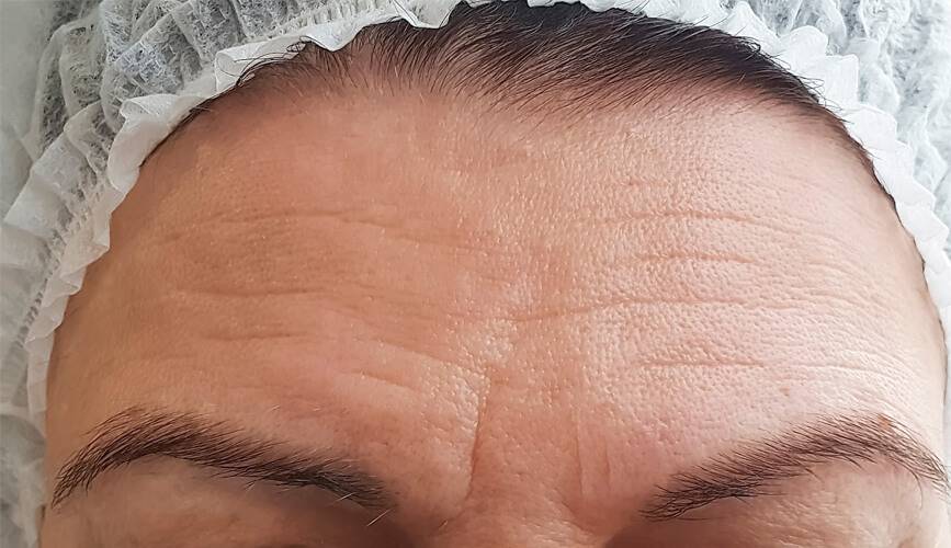 Alın Çizgileri Neden Olur? Nasıl Geçer?